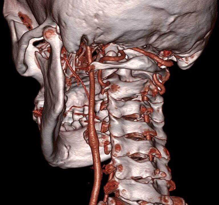 stisnjena arterija s cervikalno osteohondrozo