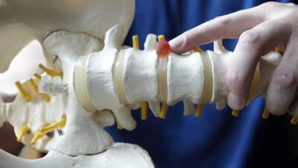 kila hrbtenice kot vzrok za bolečine v hrbtu