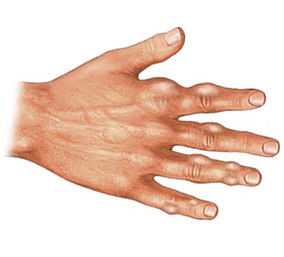 Odlaganje kristalov sečne kisline v mehkih tkivih prstov s protinastim artritisom