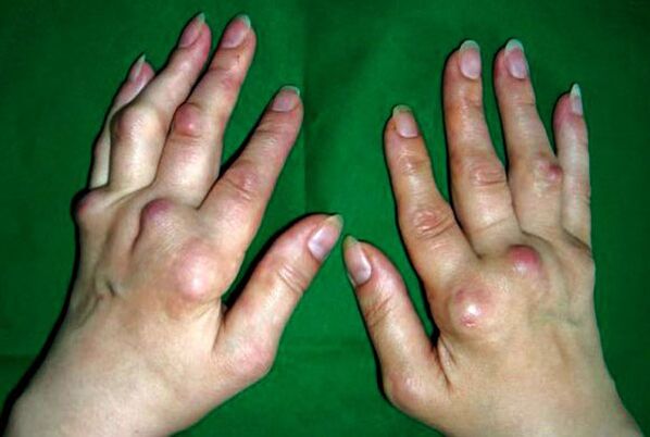 Roke, ki jih prizadene deformirajoči poliosteoartritis