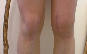 faze razvoja artroze kolena