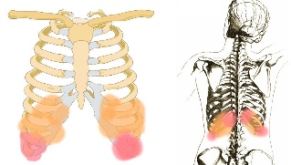 bolečine v hrbtu pod rebra simptomi