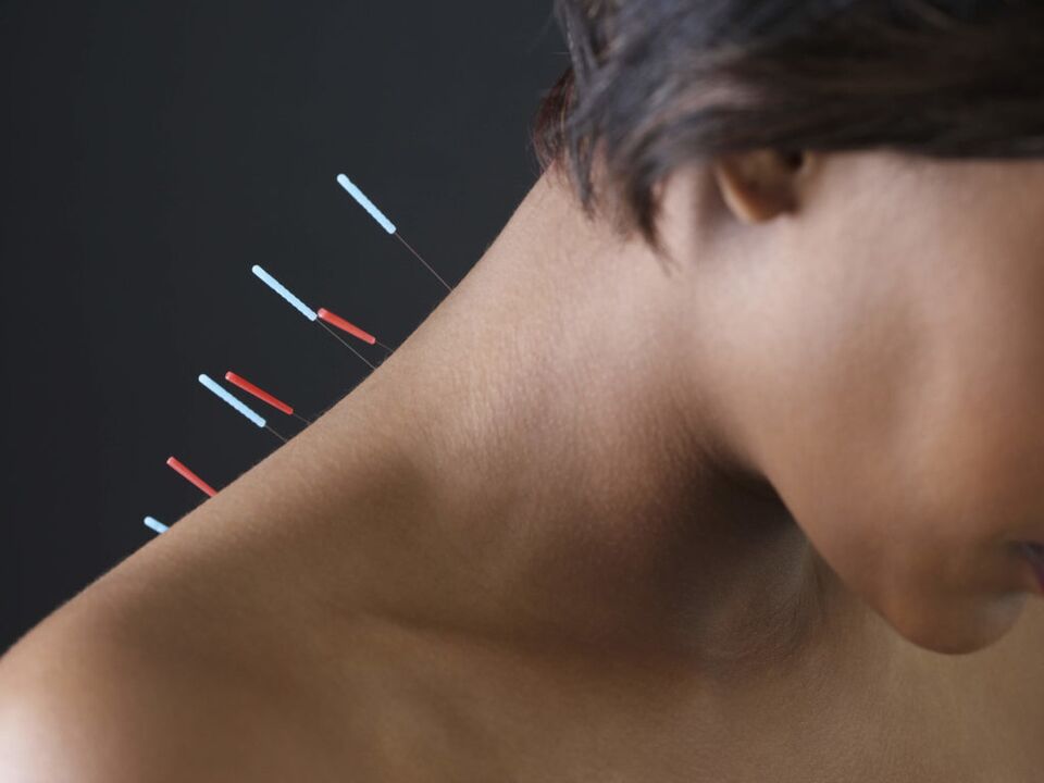 Akupunktura za cervikalno osteohondrozo odpravlja vnetne procese