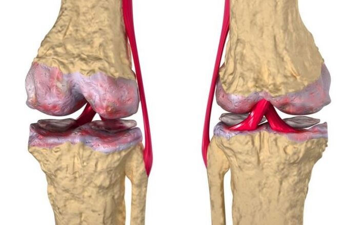 Artroza kolenskega sklepa