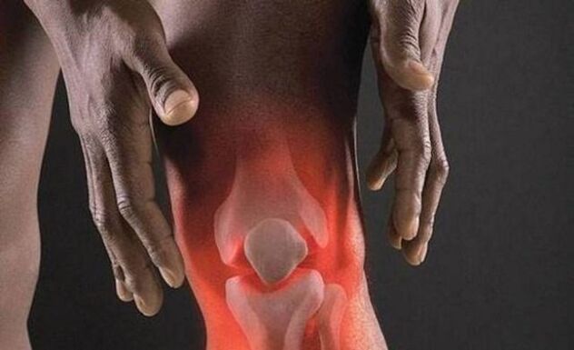 Artrozo spremlja vnetni proces v kolenskem sklepu