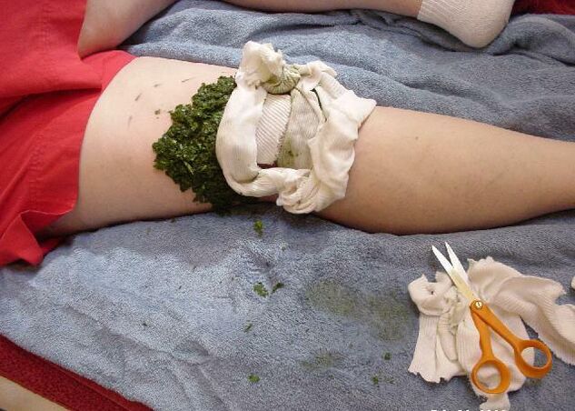 Topel obkladek iz zdrobljenih zeljnih listov na boleč kolenski sklep z artrozo